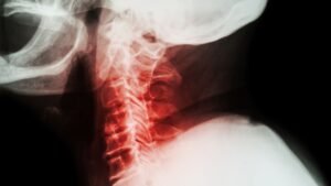Contracturas y Esguinces Cervicales